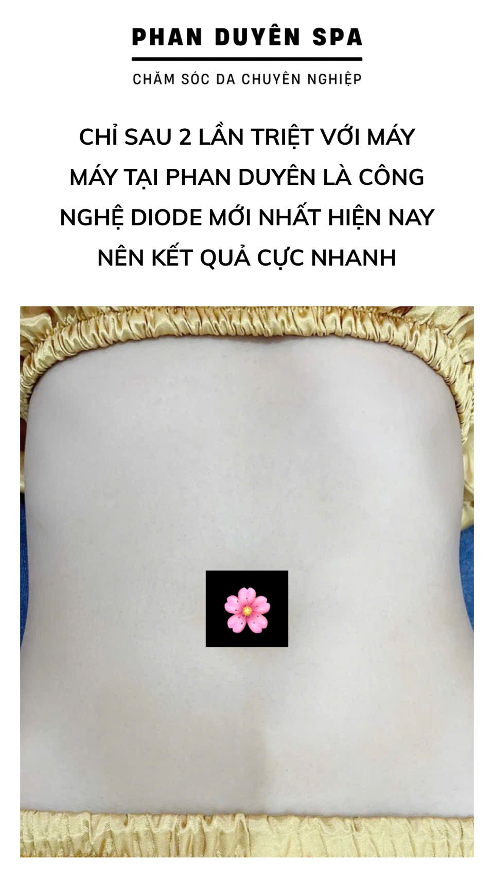 Triệt lông công nghệ Bình chánh Triệt lông công nghệ Bình chánh