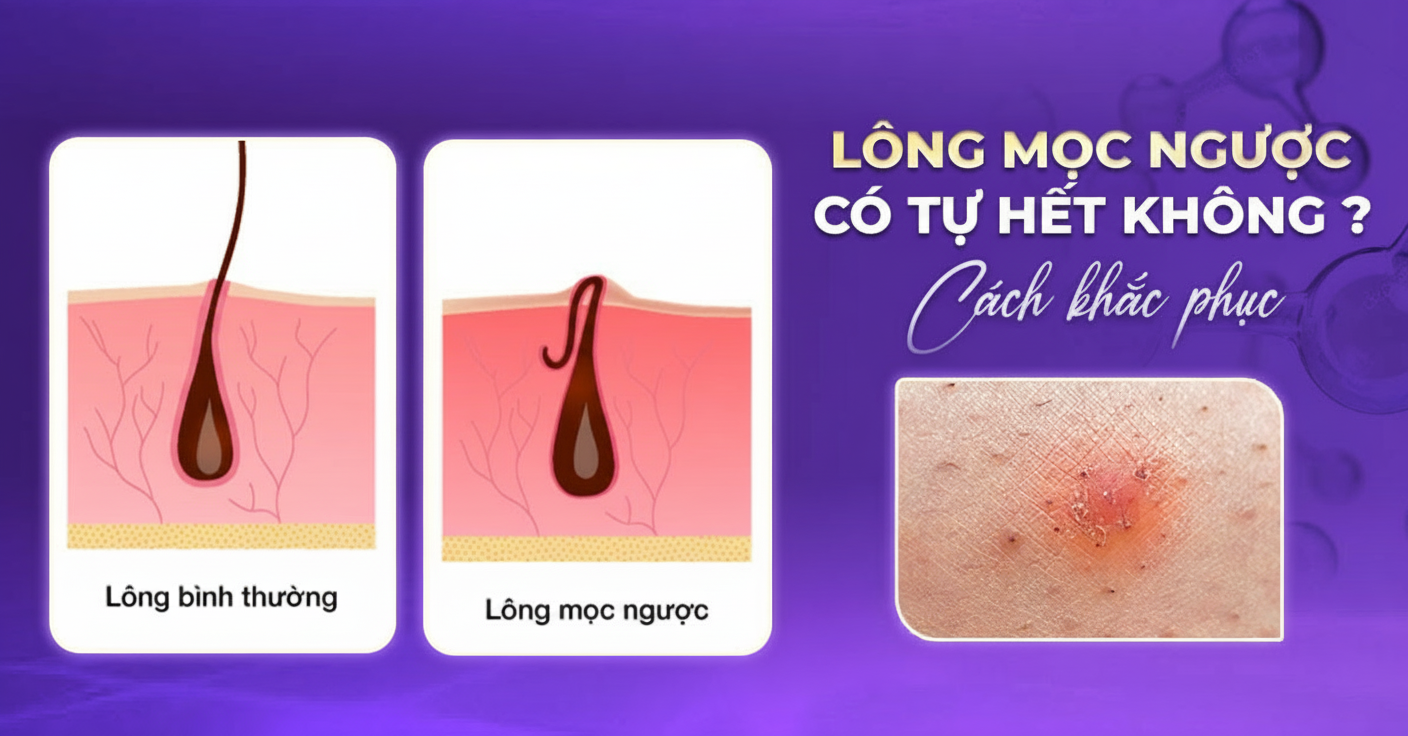 Lựa chọn thay thế